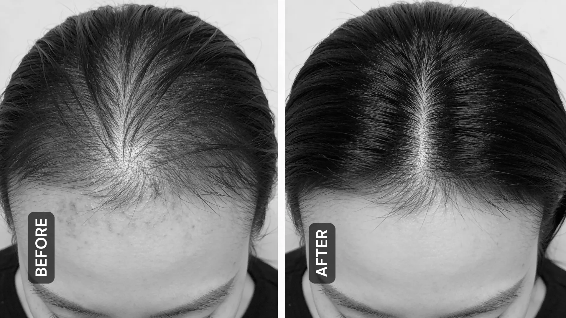 Hair Fall Results
